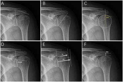 Evaluation of the prognostic value of the anatomical characteristics of the bony structures in the shoulder in bursal-sided partial-thickness rotator cuff tears